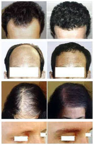 Hair replacement Malaysia